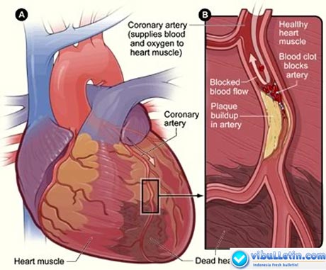 Heart Disease Cardiac Disease - Diagram
